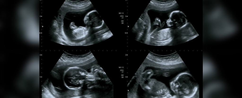 Amerykańska &bdquo;matka zastępcza&rdquo; przed sądem: zamawiający rodzice domagają się aborcji dziecka z wadą serca